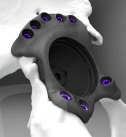Ossis_implant