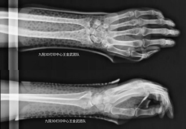 arm_2